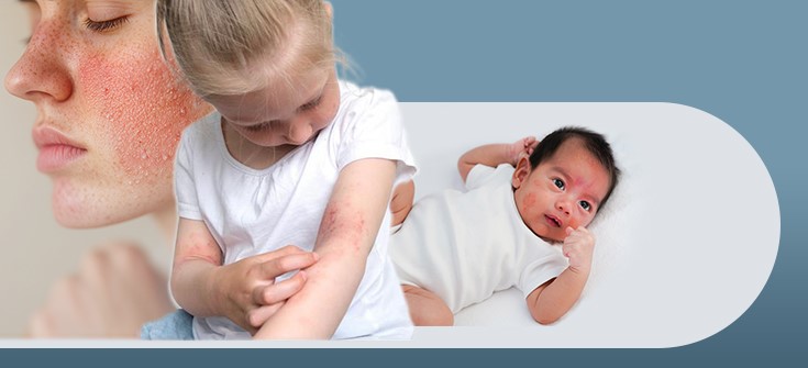 Collaborating on Individualized Management Solutions for Pediatric Patients with Moderate-to-Severe Atopic Dermatitis