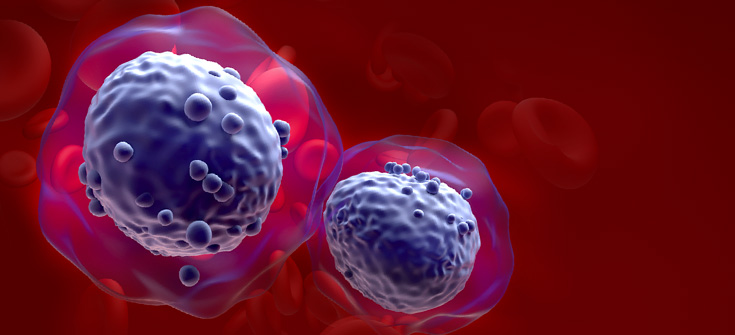 Navigating the Rapidly Evolving Classification and Treatment Landscape of Secondary AML Subtypes: Modeling Best Practices for Early Identification and Individualized Care
